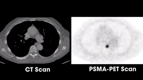 psma scan meaning